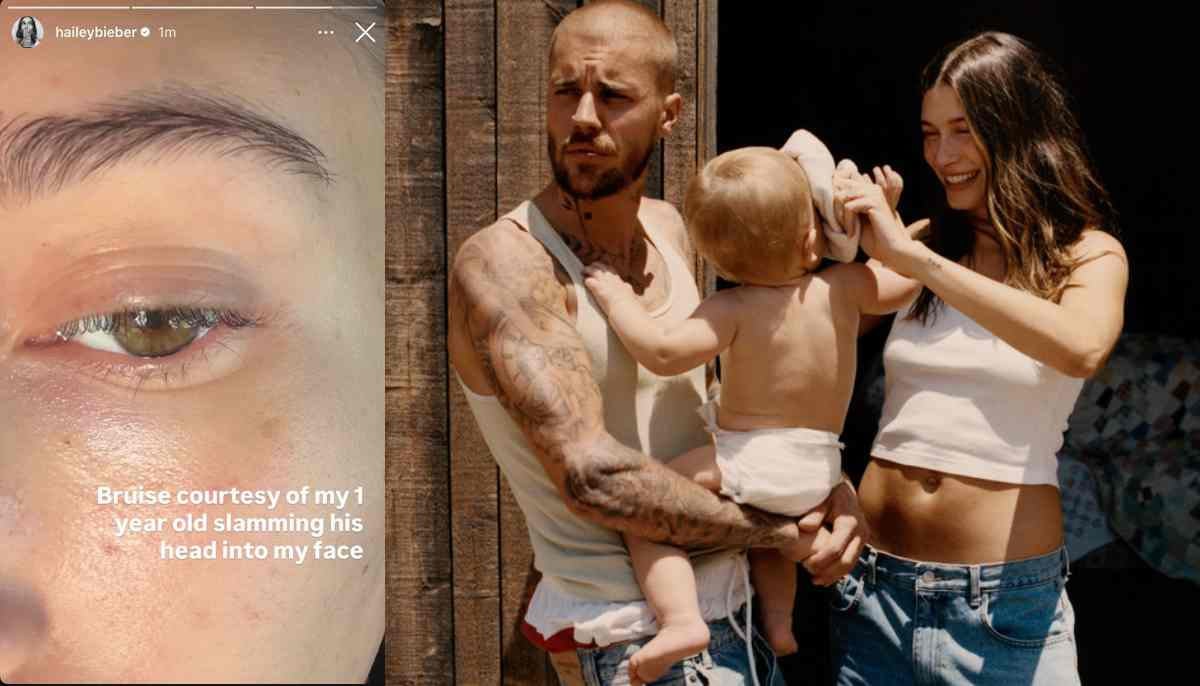 Why did Hailey Bieber delete raw snap of bruise?