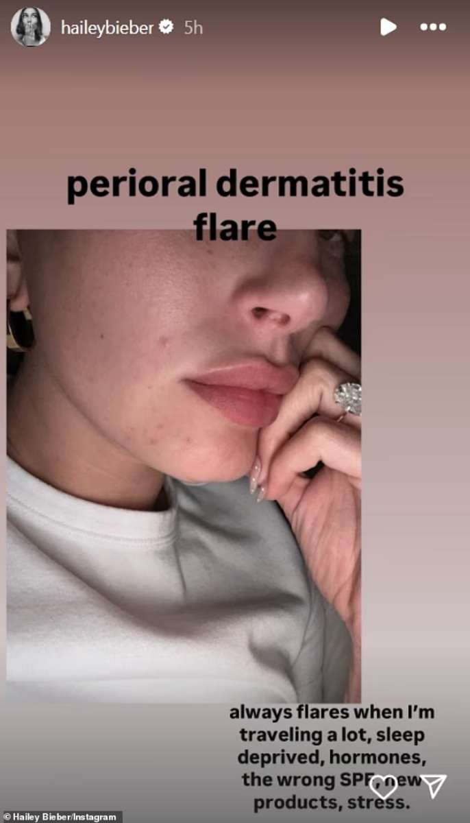 Hailey Bieber reveals painful skin flare amid Justin’s money woes