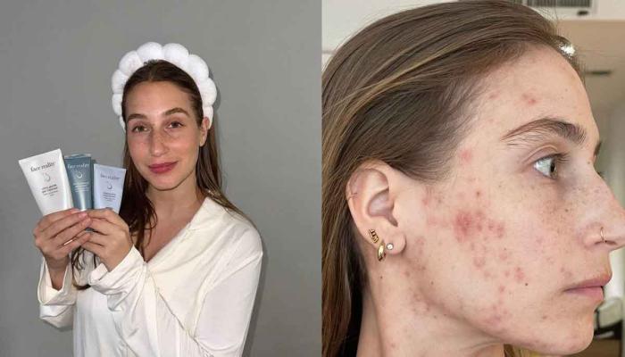 Amanda Batula reveals how she cleared her acne