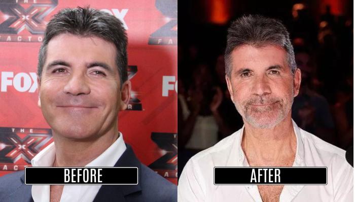 Simon Cowell denies getting done this one procedure