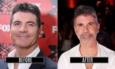 Simon Cowell admits getting Botox and cosmetic treatments 