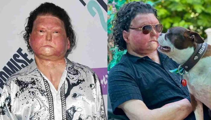 All about Joe DiMeos face transplant and journey of survival