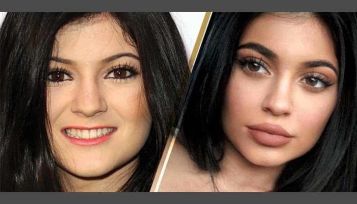 Kylie Jenner returns to natural look decade after viral cosmetic surgery